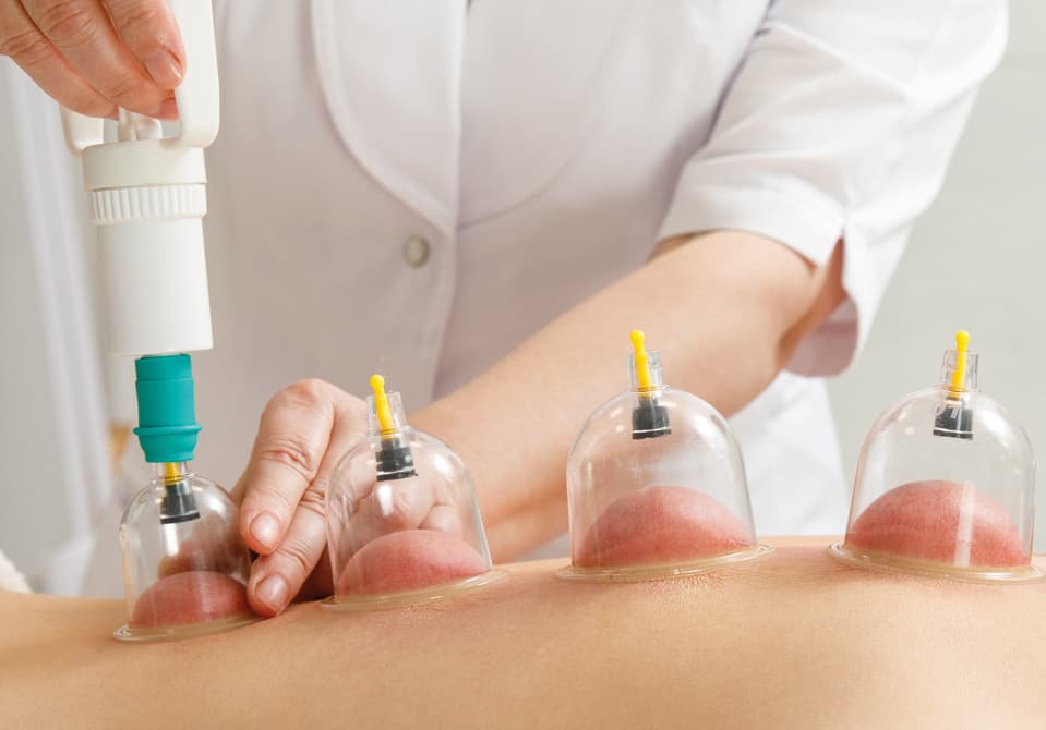 Hijama cupping treatment in progress at Royal Treat Clinic