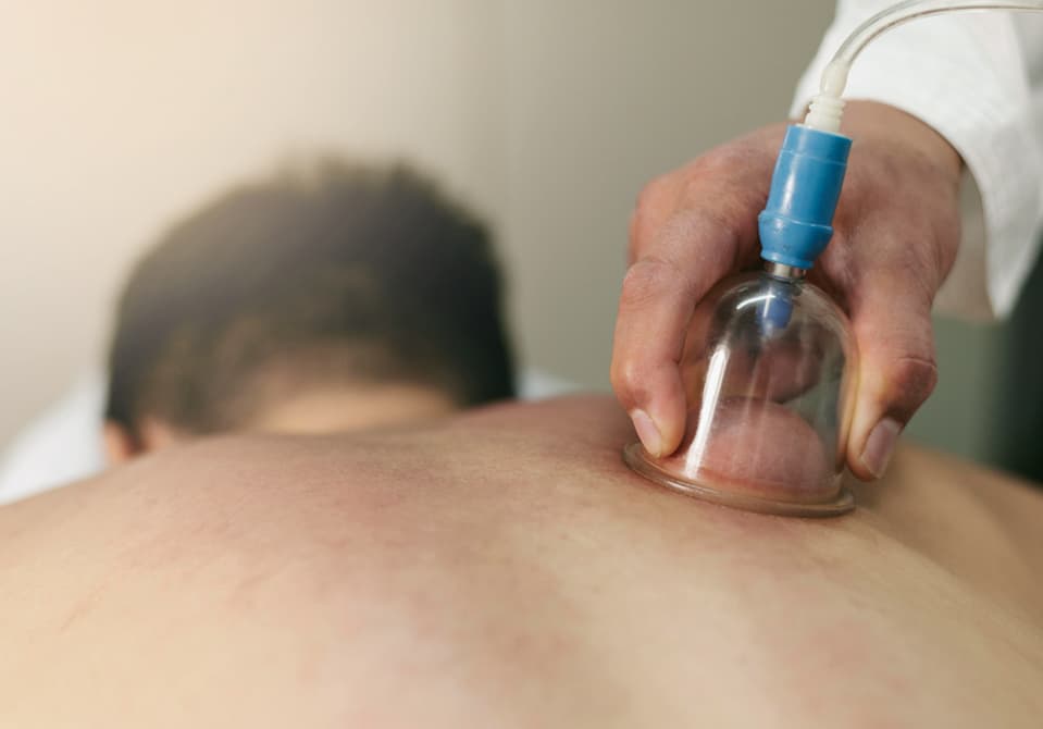 Hijama therapy performed by specialist at Royal Treat Clinic Dubai